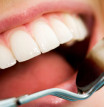 Dantų ant implantų priežiūra