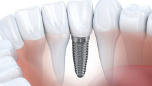 Straumann dantų implantai